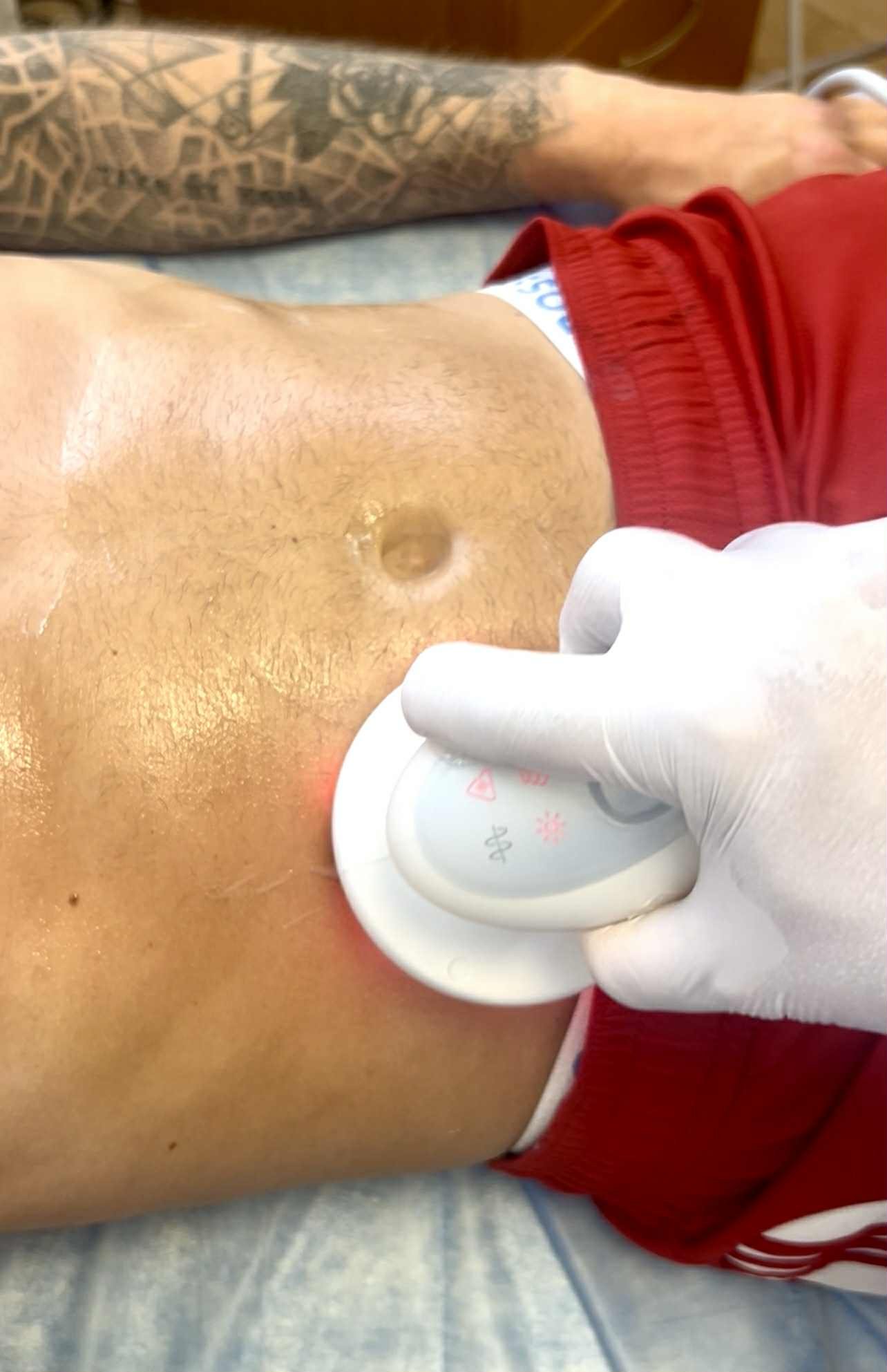 cavitation et radiofrequence lyon